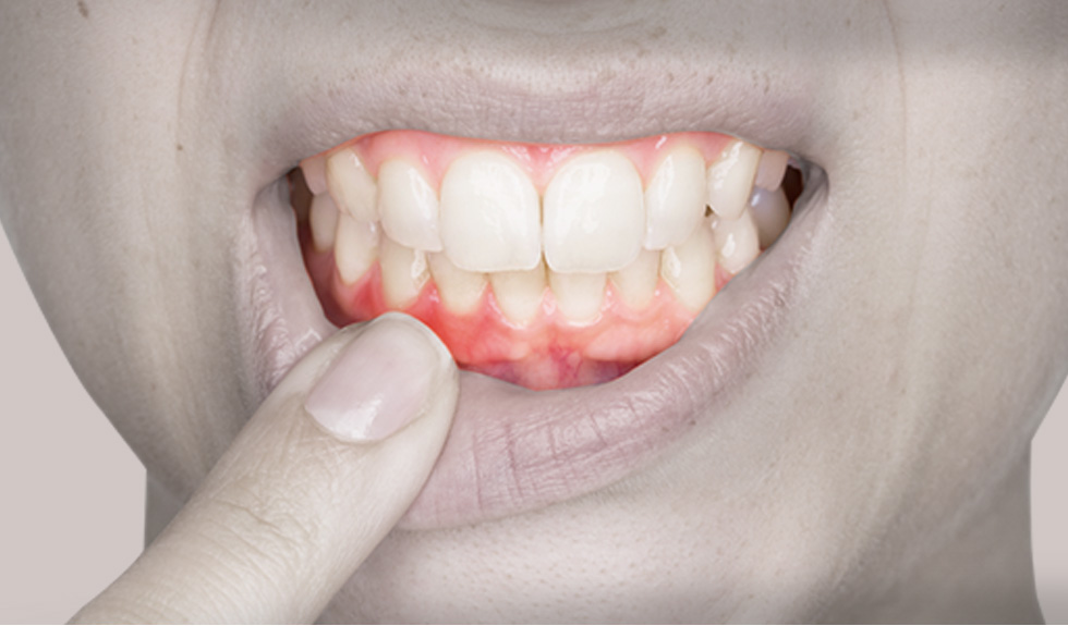 自宅ホワイトニングは歯を溶かしたりエナメル質にダメージを与えることはあるの？